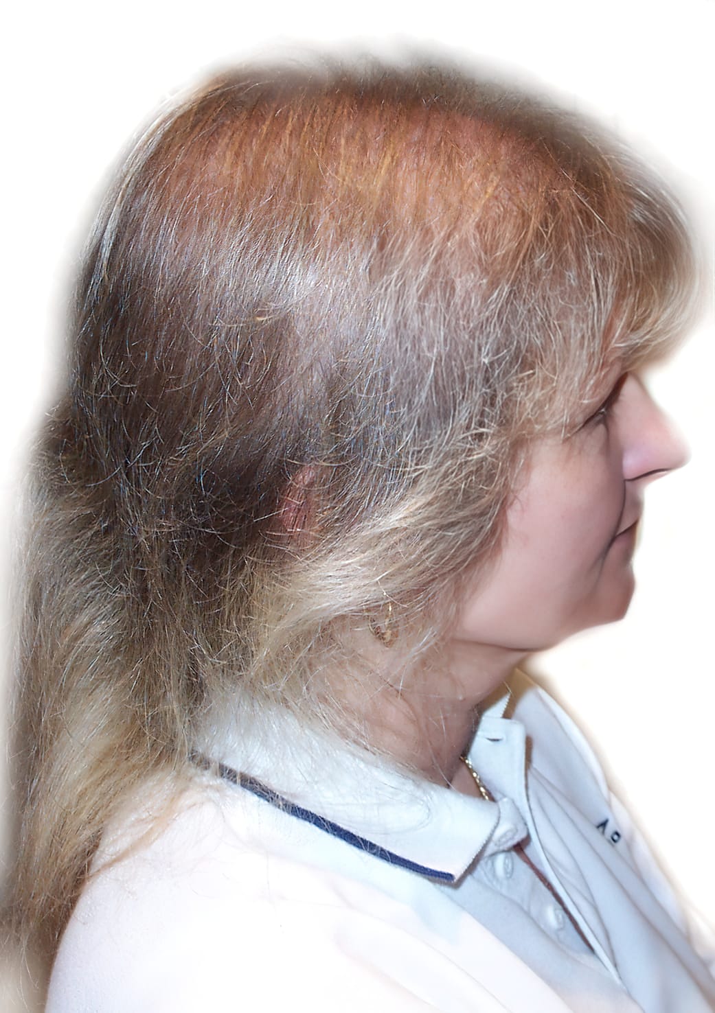 Before Picture - Androgenetic Alopecia